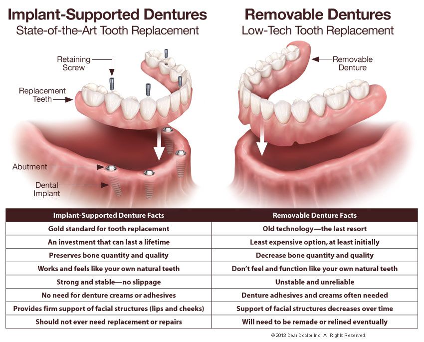 Dental denture implants implant full dentures teeth supported overdenture cost conus prosthesis mouth indications price contraindications missing tooth made either