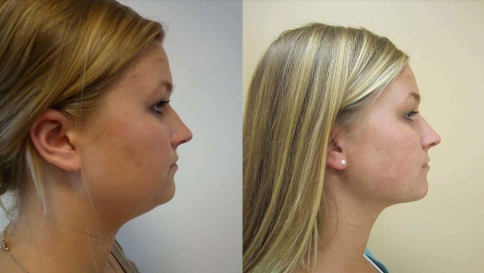 How much does a neck lift cost