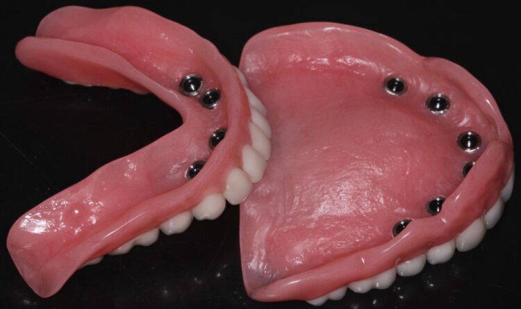 How much do snap-in denture implants cost