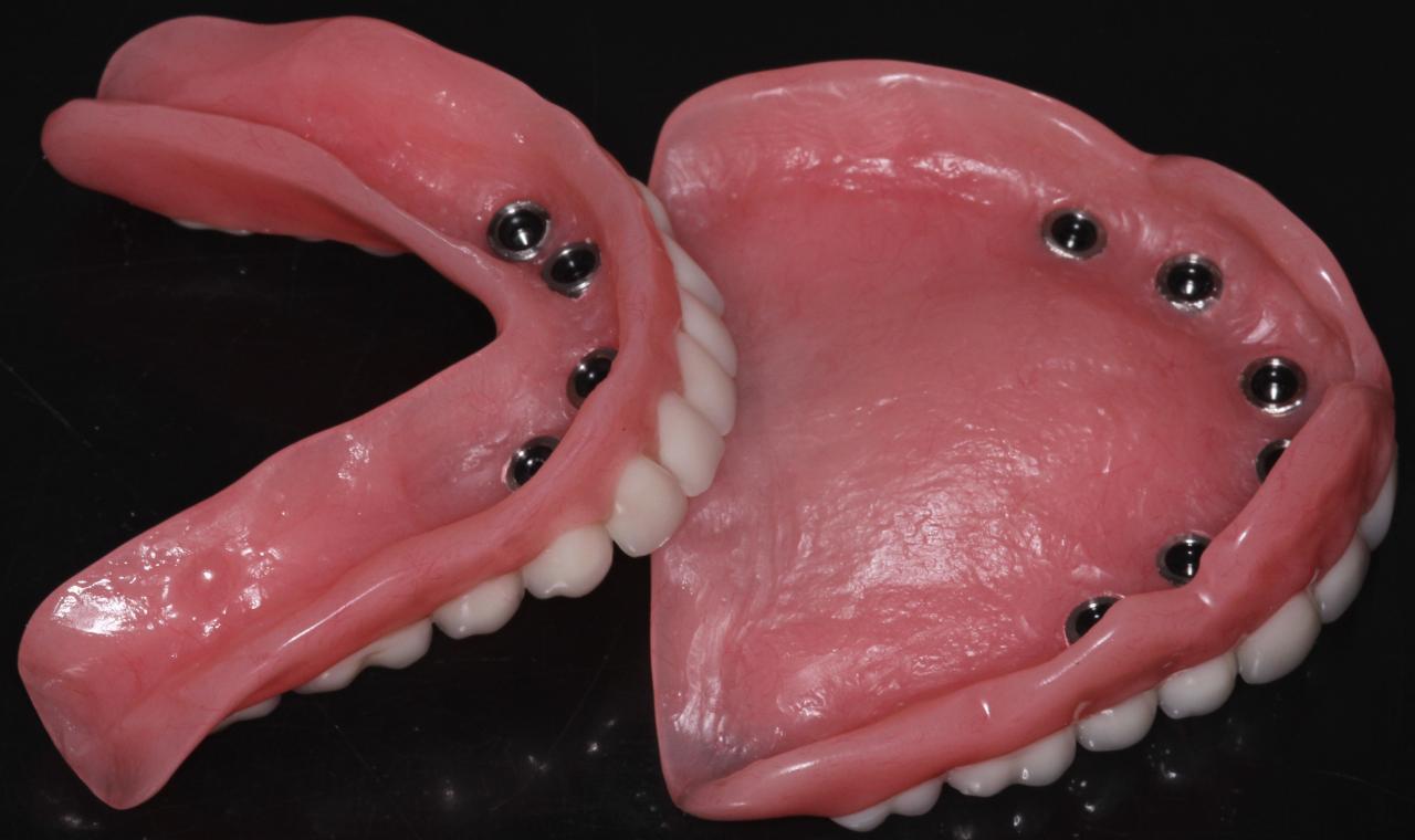 How much do snap-in denture implants cost