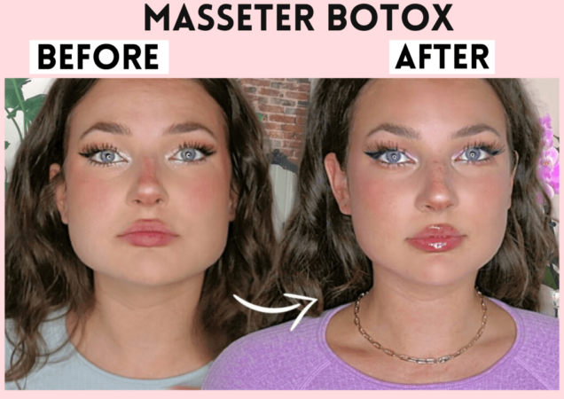 How much is masseter botox