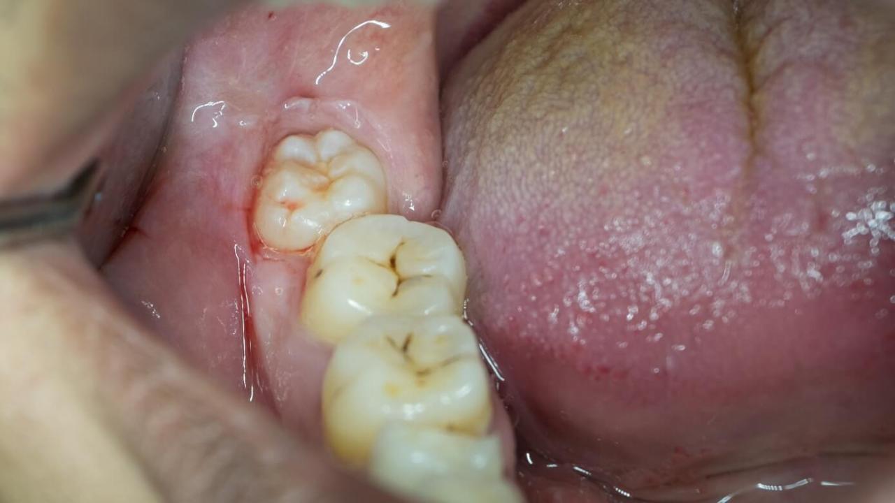 Wisdom tooth growing pain how long