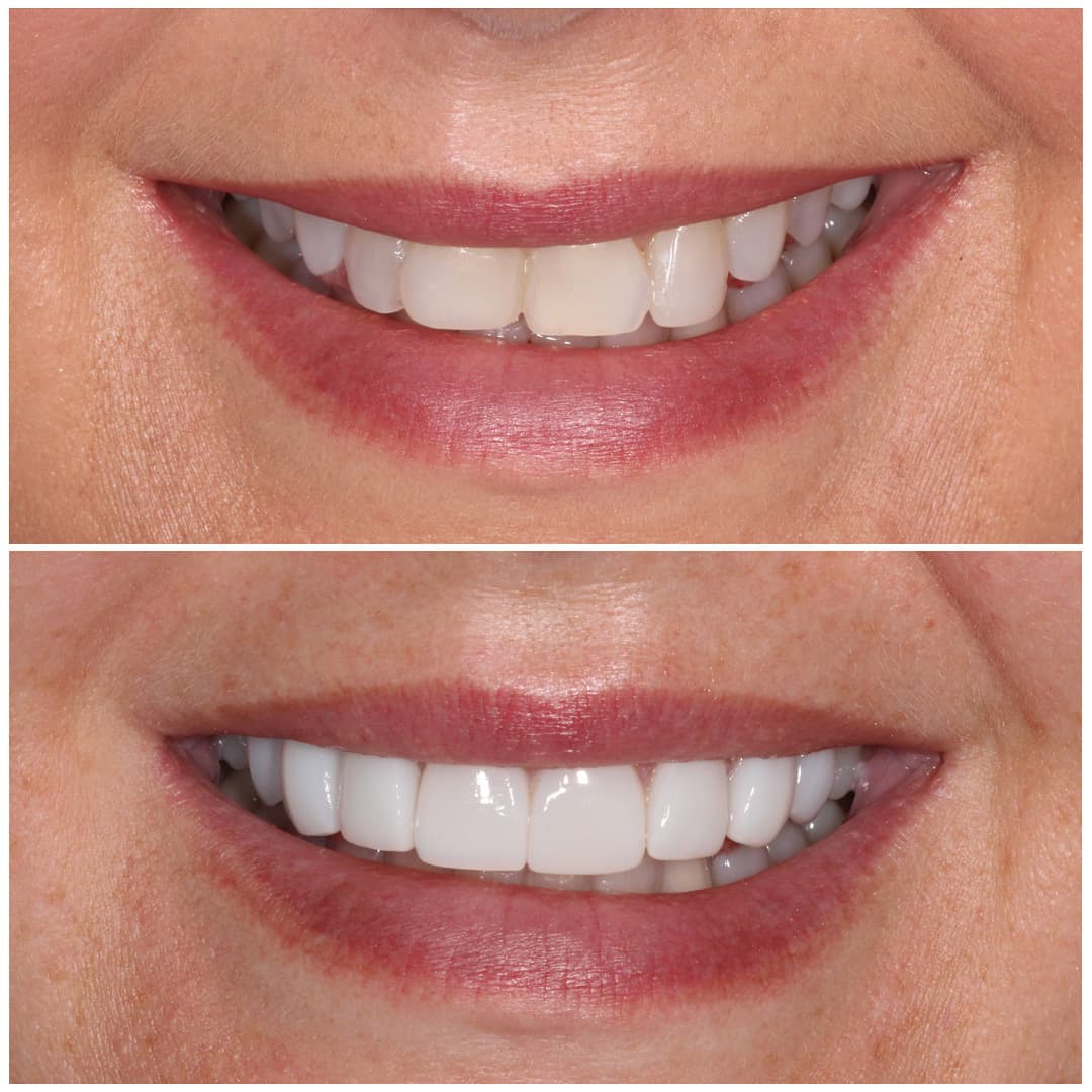 Bonding dental smile veneers dentist dentistry remains option