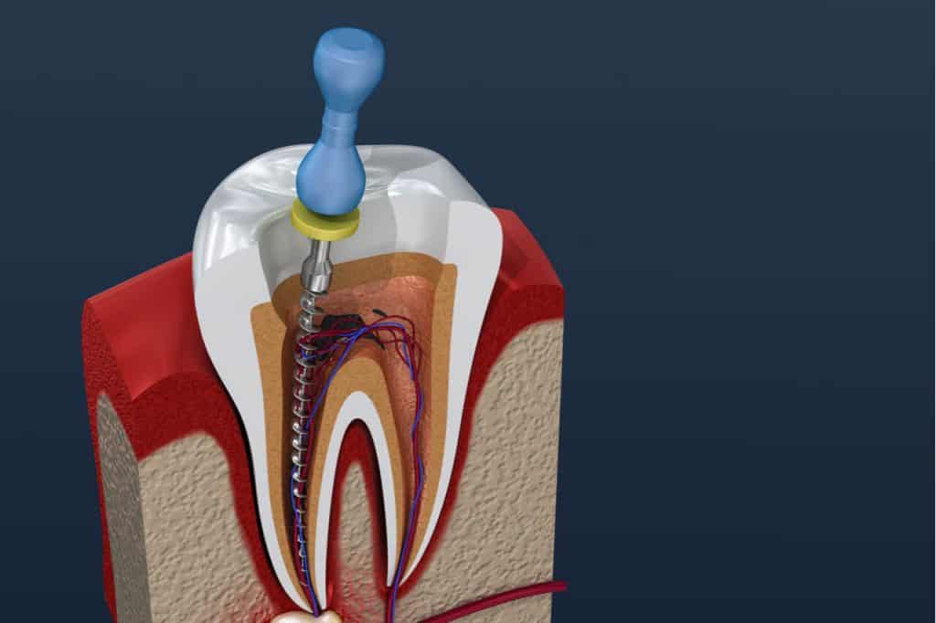 How to stop throbbing pain after root canal